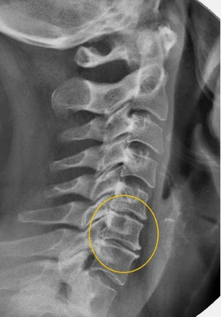 Osteocondrose da columna cervical nunha x raios
